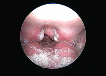 Diphtheria infection outbreak claims 25  lives