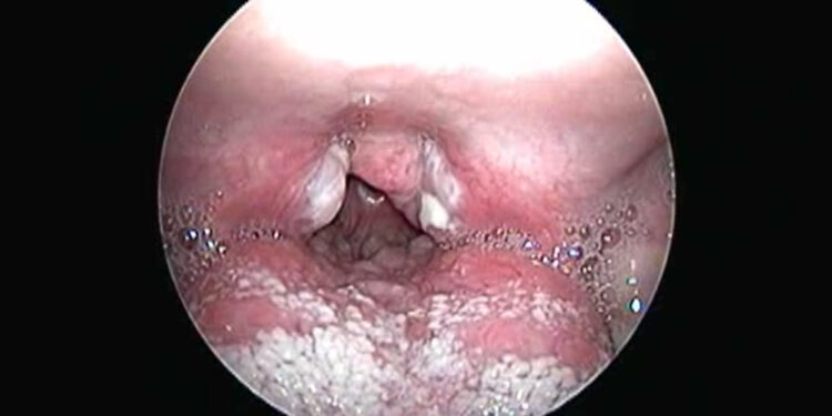 Diphtheria infection outbreak claims 25  lives